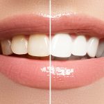 Best Teeth Whitening Kit