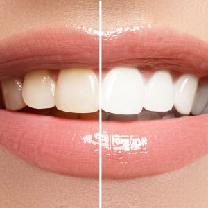 Best Teeth Whitening Kit • Reviews & Buying Guide (November 2024)